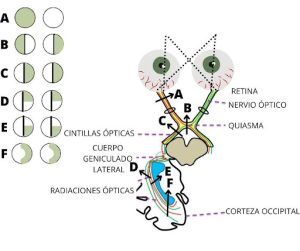 alteraciones del campo visual
