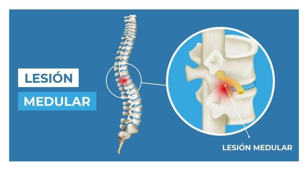 lesión medular espinal