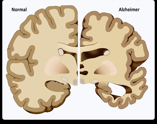 alzheimer antes y después