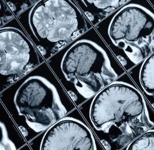 lesion focal cerebral