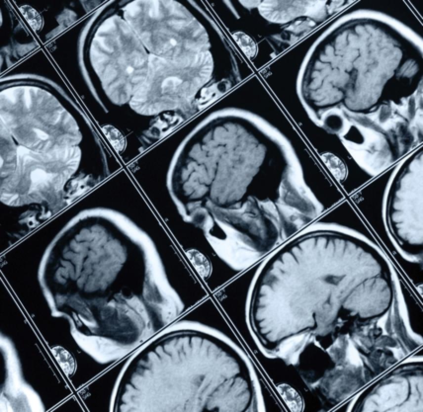 lesion focal cerebral
