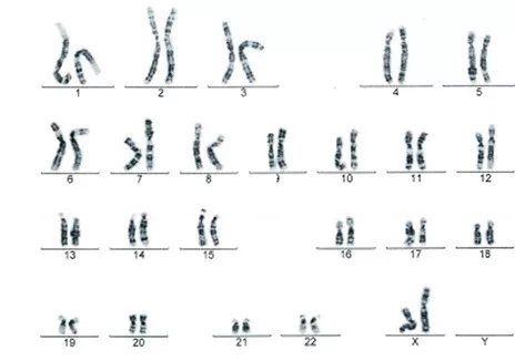Síndromes en el cromosoma 22q - Uner