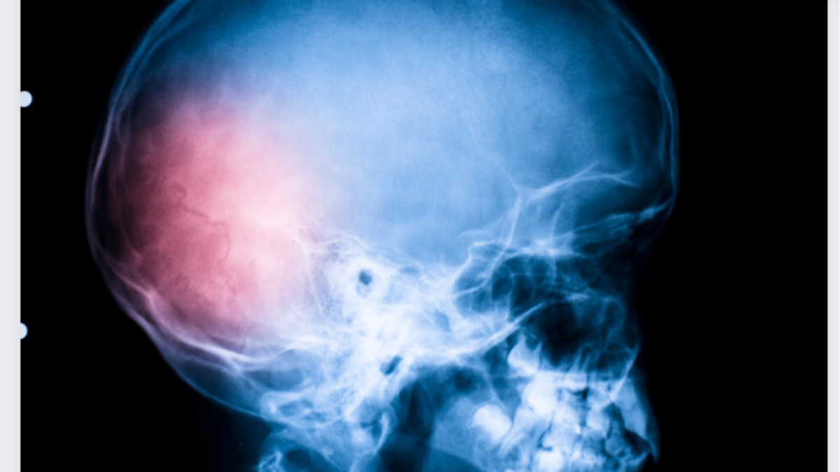 Fisioterapia Cranium: Muñeca abierta, qué es y cómo tratarla