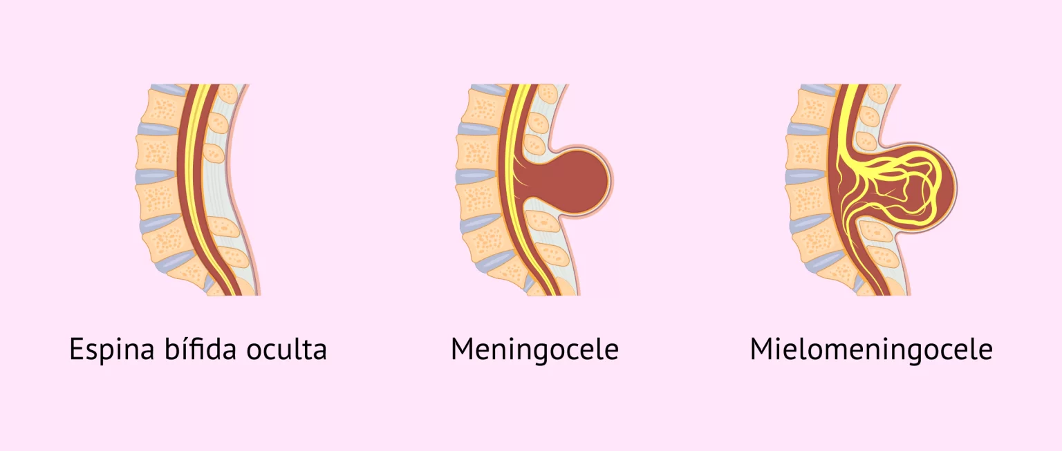 Espina Bífida Guía Completa Clínica Uner 8927