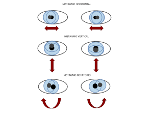 Hipoplasia bilateral del nervio óptico