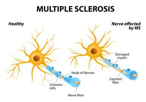 Síntomas de la esclerosis múltiple