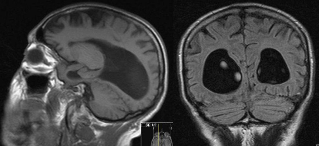 Síndrome de agenesia del cuerpo calloso Clínica Uner