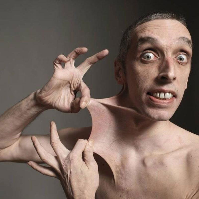 🦴 Síndrome de Ehlers-Danlos: Causas, Síntomas y Tratamientos 🩺